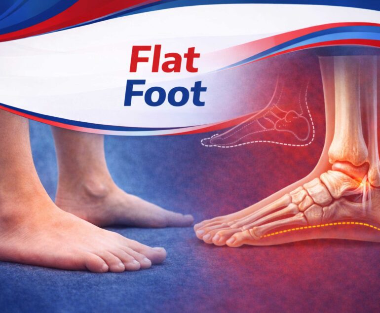 Flat Foot Treatment in Raipur